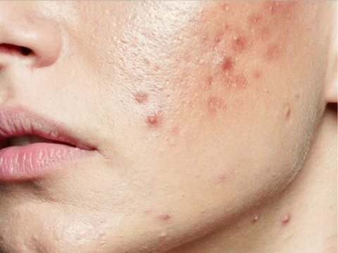 Tudo o Que Precisa de Saber Sobre a Acne